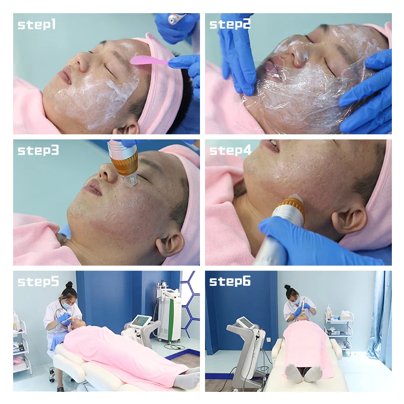  acne removal skin care 5Mhz Micro needle MFR SFR Microneedle Fractional Machine intracel rf micro