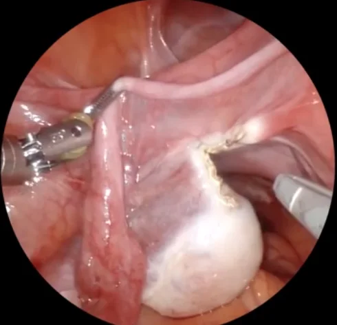 ligasure  bipolar electrosurgical devices