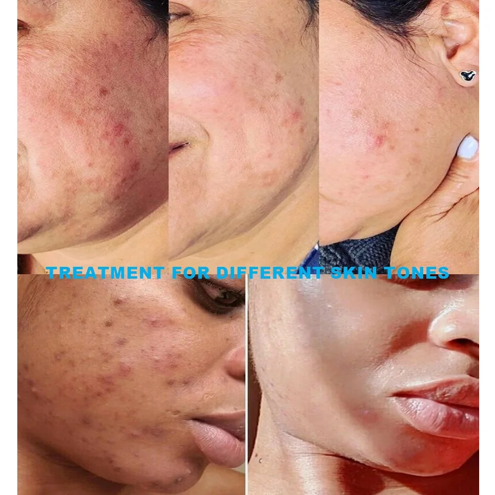 Private Label Natural Acne Cream Skin Care Repair Anti Acne Pimple Removal Salicylic Acid Cream