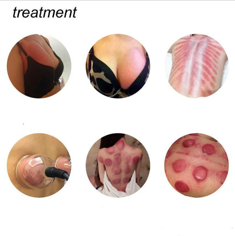 Anti Cellulite Massage Cupping Set Suction Cups Vacuum Therapy Machine Ventosas Masajes Ventouse Electrodes