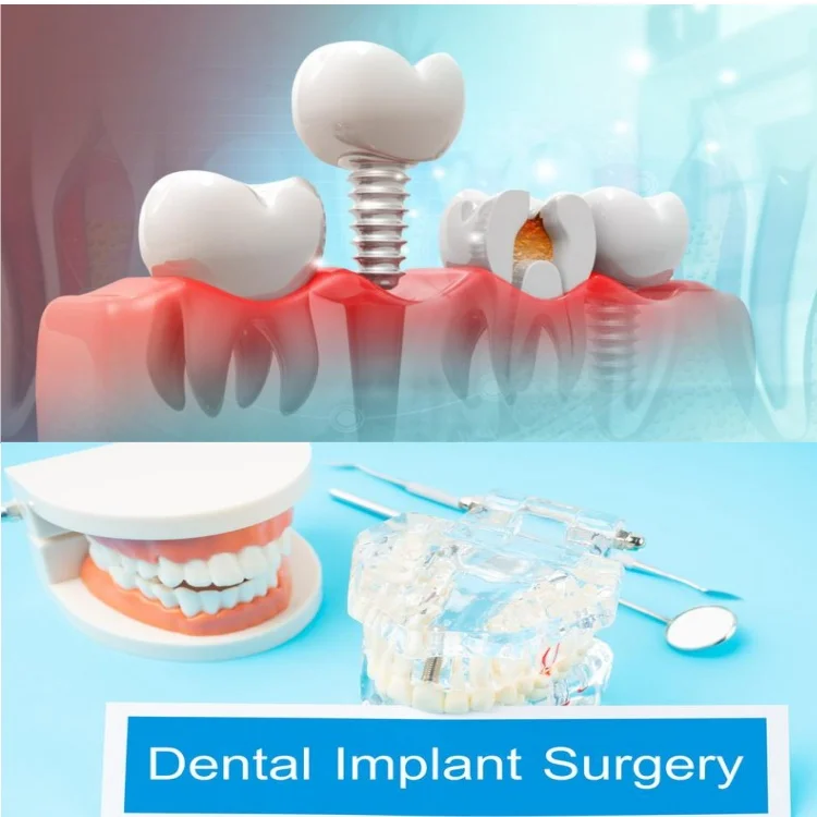 CAD Cam Designed Lab Dental Zirconia Implant Crowns and Bridge Over Titanium Bar
