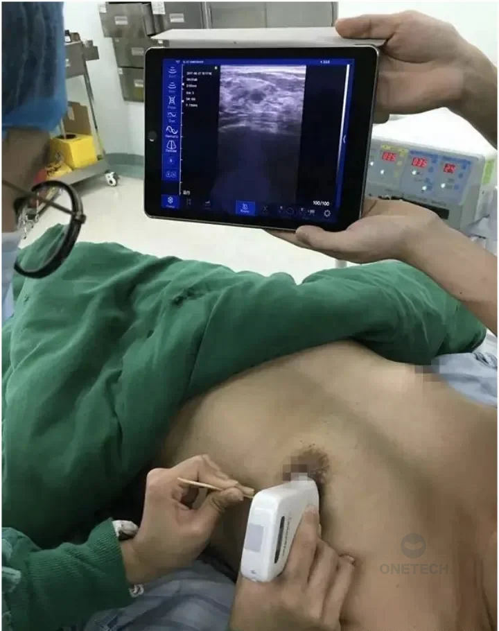 C37A Portable 128 Element Wireless vascular USG Ultrasound Linear Ultrasound Probe