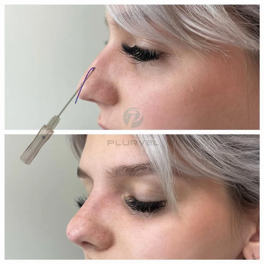 2023 Korea lift pdo pcl threads lift molding cog for skin tightening nose cog thread