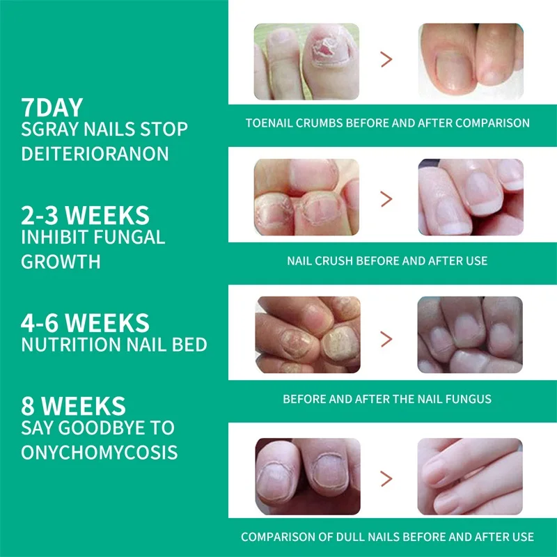 Organic Fungus Nail Repair Essence Toe nail Fungus Remover Treatment Solution