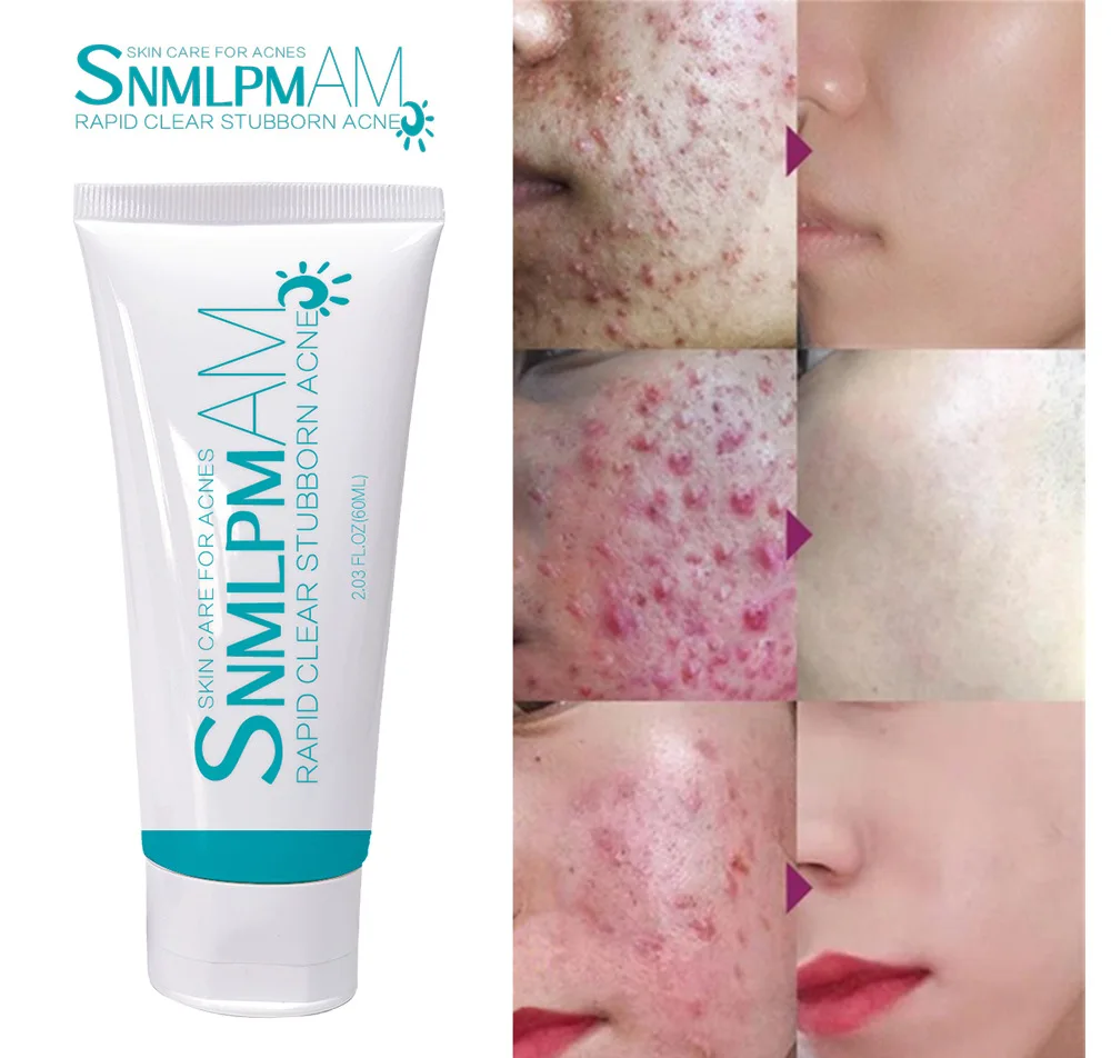 Skin Care Repair Best Acne Cream Treatment Ance Scar Removal Cream Anti Acne Epiderm Cream For Acne