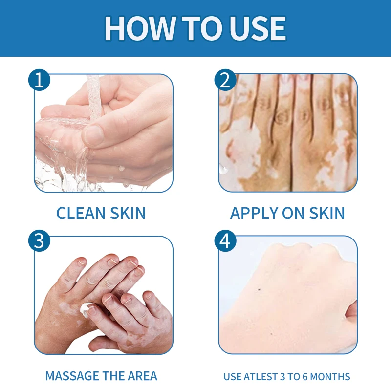 20g vitiligo ointment Body white spots pigmentation skin itchy scars vitiligo