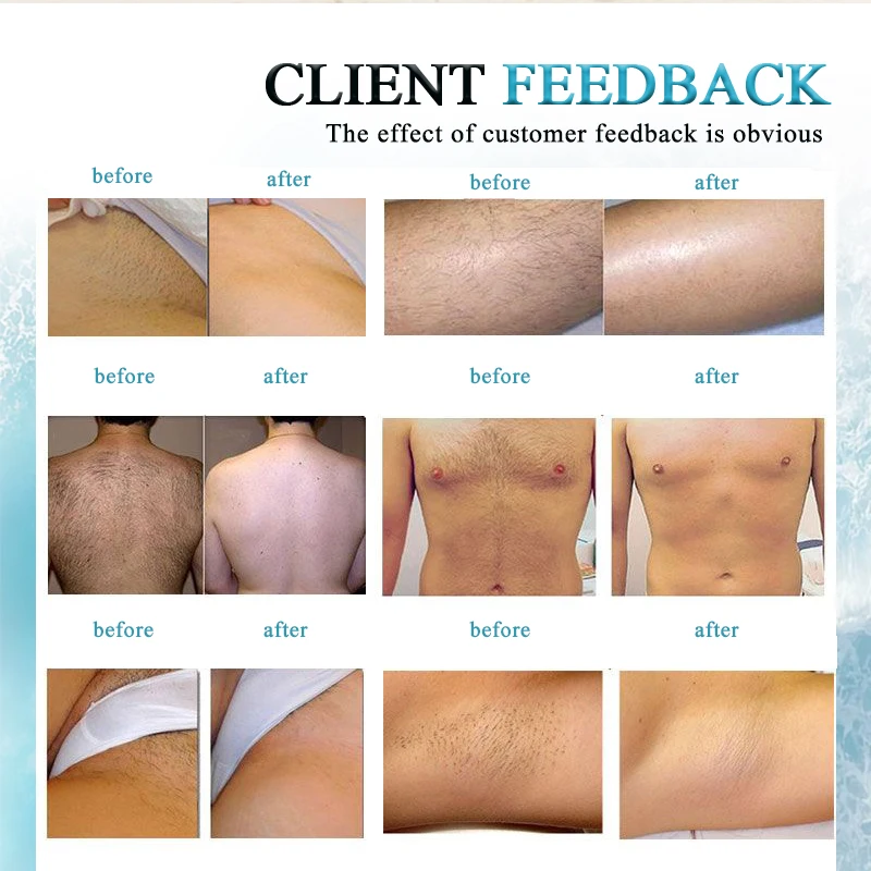 Winkonlaser Latest 4K 1200W 4 Wave 940Nm Laser Diode Hair Removal/755 8081064 Diode Laser Machine Price