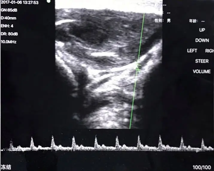 SY-5L Line array wireless probe ultrasound machine hospital medical device color doppler linear probe ultrasound