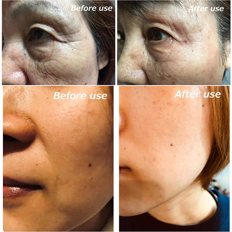 Japan hyaluronic acid hyaluronic acid patches anti wrinkle for sale