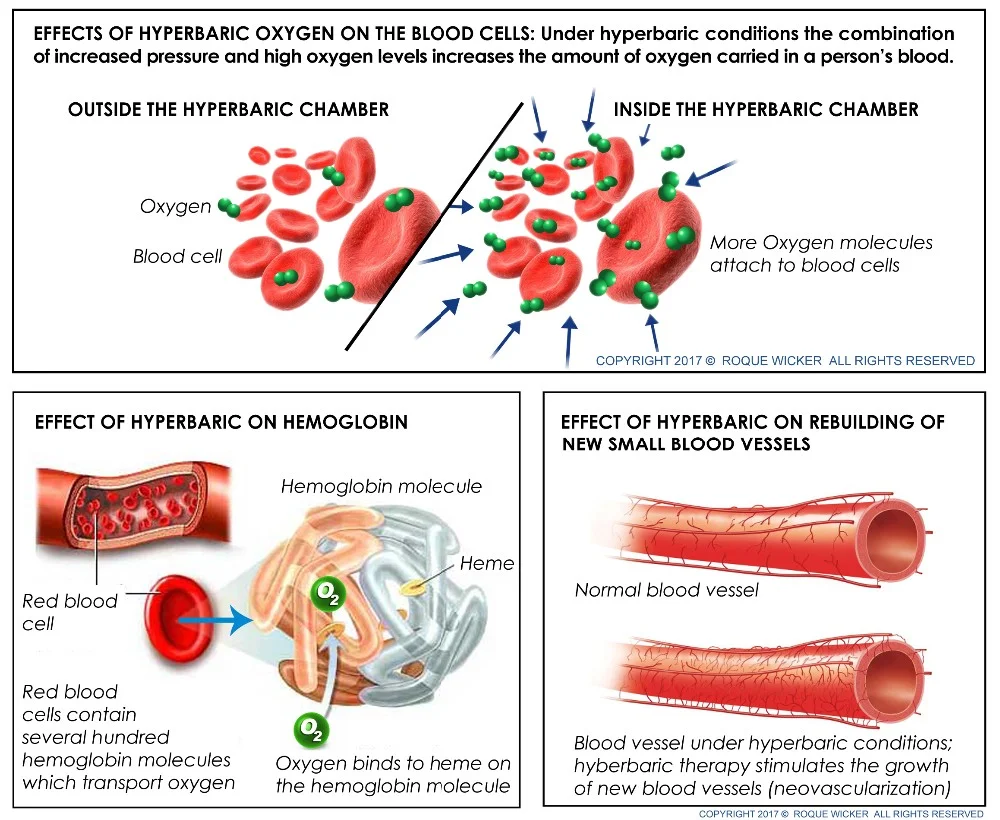 HBOT Macy-pan Sitting Type  macy-pan portable hyperbaric oxygen tent ST2200 for keep fit