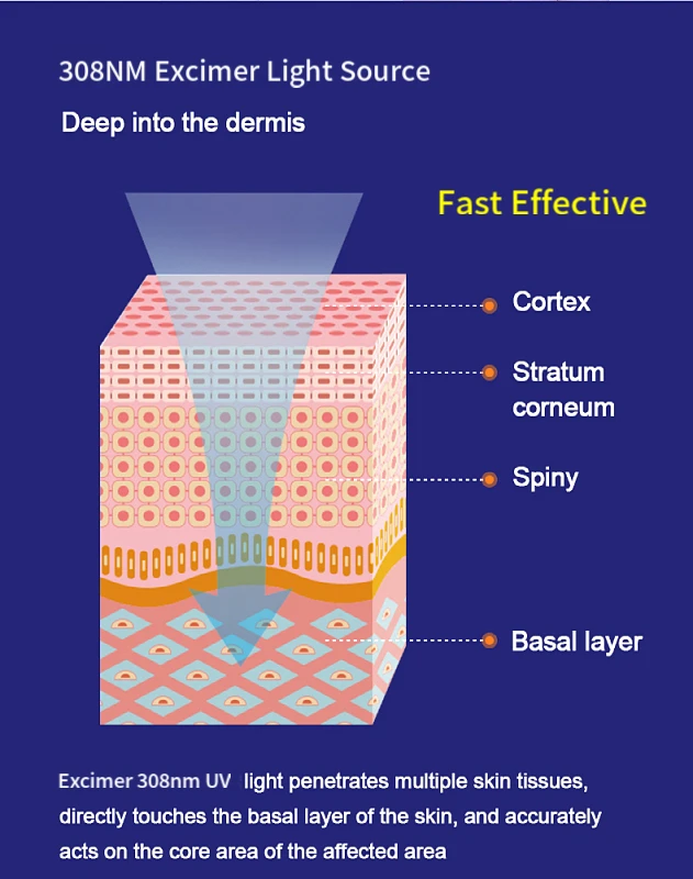 25mW Targeted 308nm Excimer Laser
