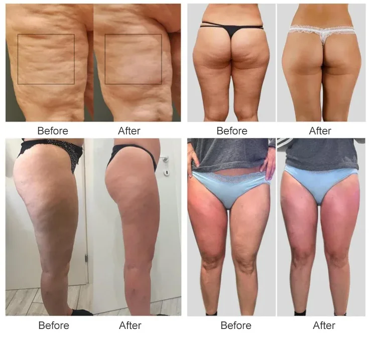 Cheap Price NEW selling inner Ball Roller Endos Slimming Machine