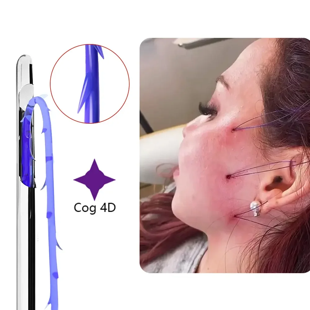 REJEON pdo thread lift korea 3d 4d 6d cog pdo  thread lift face pdo faden nadel