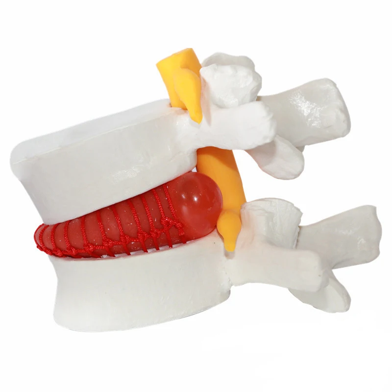 Assisted teaching Demonstration model of lumbar disc herniation Model intervertebral disc model