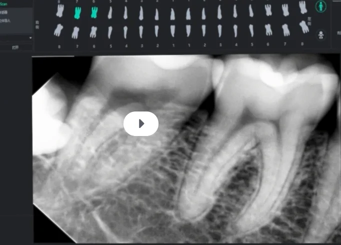 Factory price Dental Intraoral X-Ray Sensor Digital RVG HDR CMOS intraoral sensor