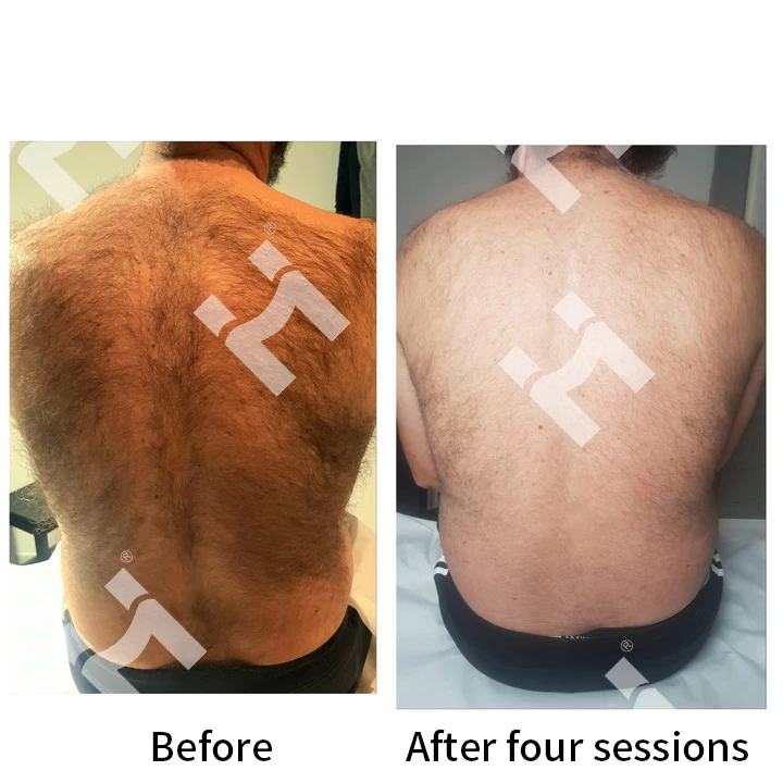 Rejuvenation with Cheap Price for Distributors Hair Removal Laser 755 808 1064nm Permanent Hair Removal Machine with Painless