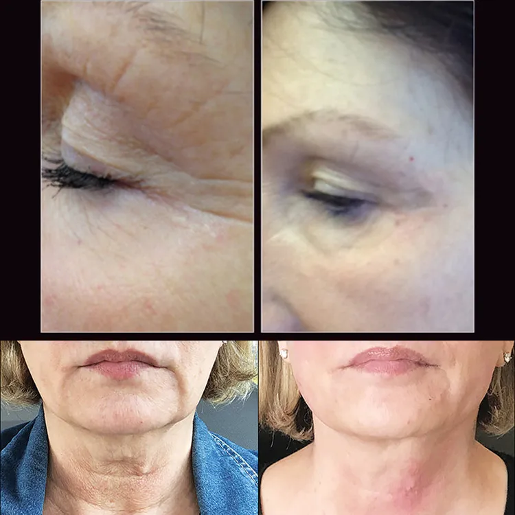 PCL Tornado Screw Thread tighten and lifting neck and face 26G*38/60/90mm 27G*38/50mm