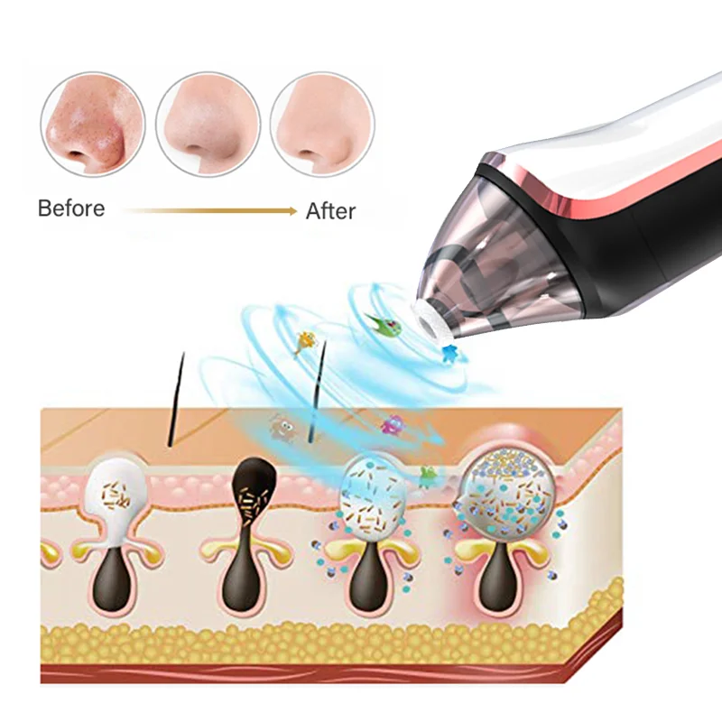 Custom wholesale electric pore nose cleaner  mobile phone visual portable mini facial whitehead vacuum blackhead remover