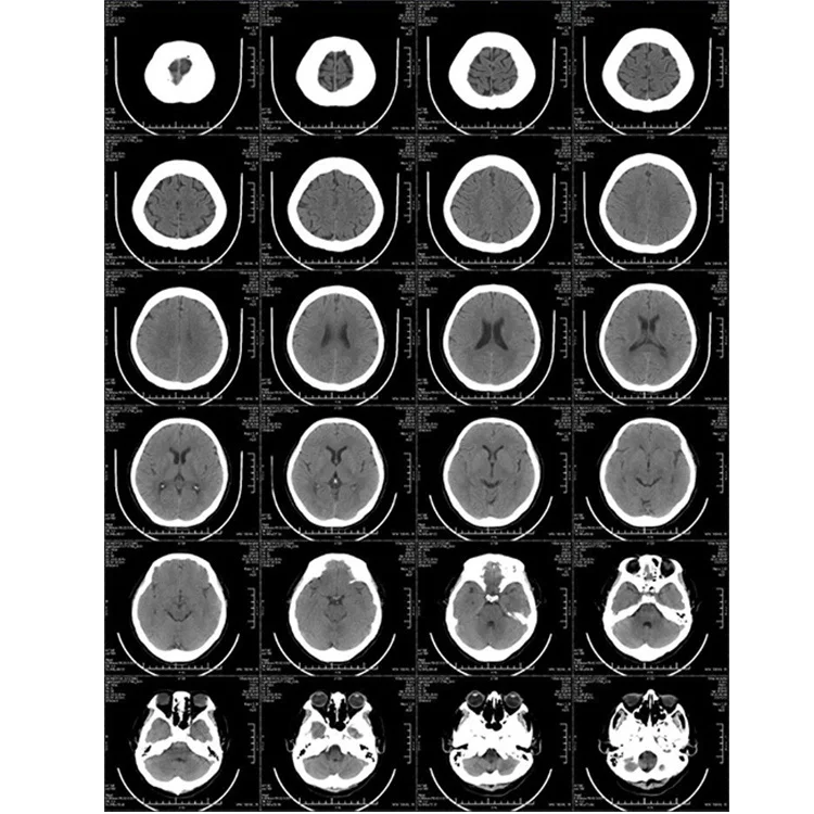 Manufacturer Medical Blue Based Inkjet Film Medical Laser Film Radiology Printing Waterproof Scanner X-ray  Film