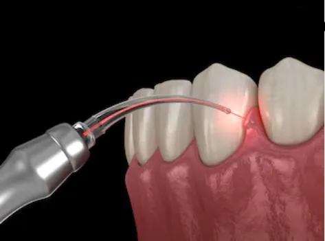 2023 Hot Selling Soft Tissue 10W 980 nm Dental Diode Laser