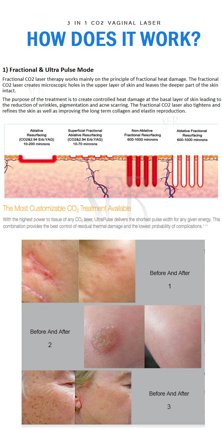 co2 laser Skin Tighten acne treatment skin resurfacing Scar Removal Co2 Fractional Laser Machine