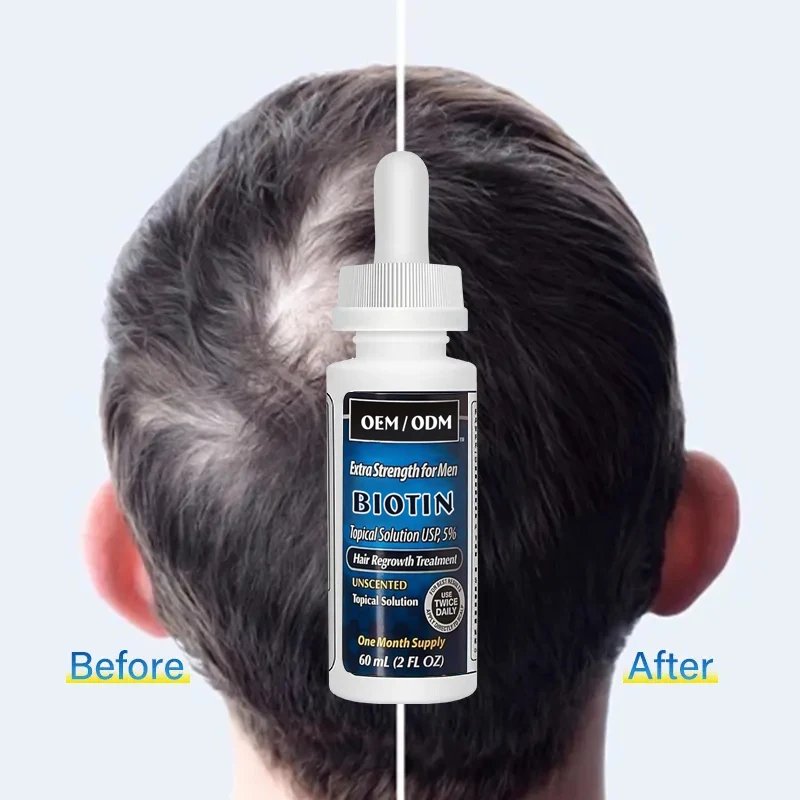 OEM ODM 2% 5%Hair Regrowth Treatment Serum Prevents Hair Loss Hair Growth Oil For Men And Women