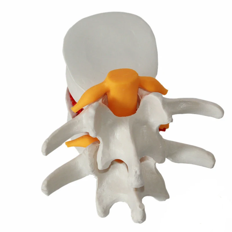 Assisted teaching Demonstration model of lumbar disc herniation Model intervertebral disc model