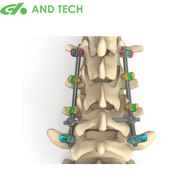 И технический производитель в Китае, Цзянсу, имплантат с тупым концом, титановый матический имплантат для спинночной хирургии