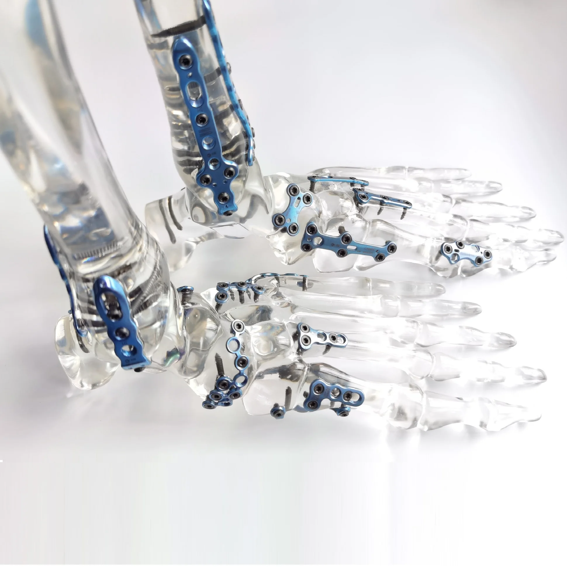 Canwell Foot and Ankle Locking Bone Plates, Distal Tibial Orthopedic Implants