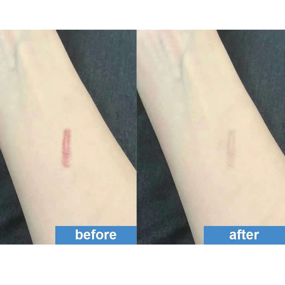 Silicone Scar Sheets, Silicone Scar Sheets for C-Section Wounds,Suitable for All Skin Types