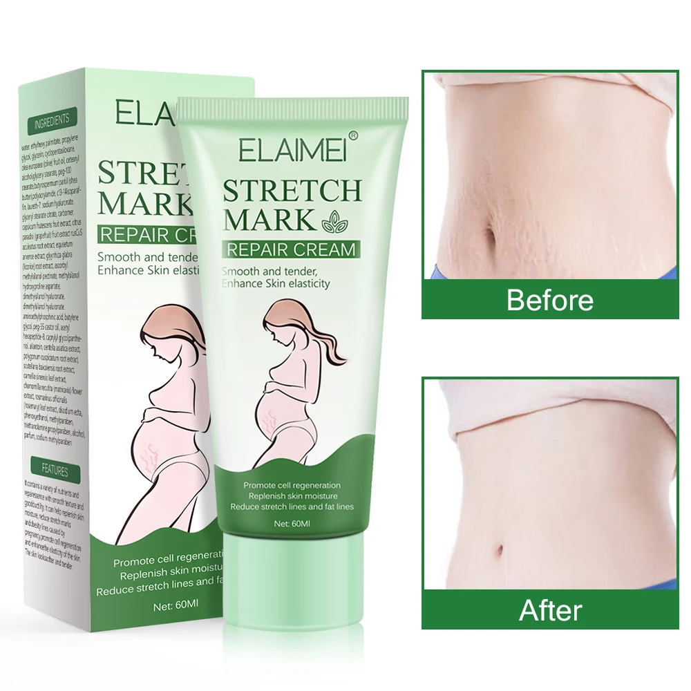 ELAIMEI Beauty Products Anti-Stretch Mark Cream Best Buttock Abdominal Pregnancy Stretch Mark Removal Cream for Legs and Thighs
