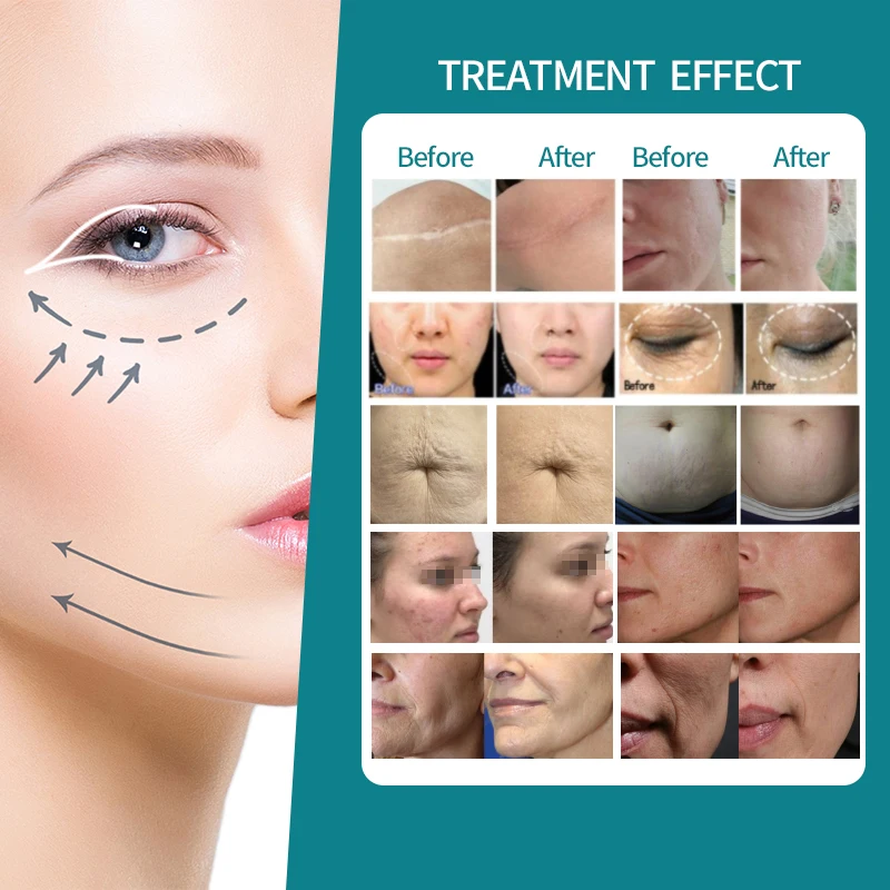 KES Portable Micro Needle Fractional Rf Facial Lifting Machine Fractional RF Microneedle for Face Treatment