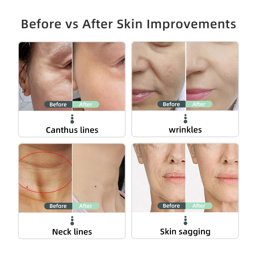 anti pigmentation ultrasonic home use hand held rf