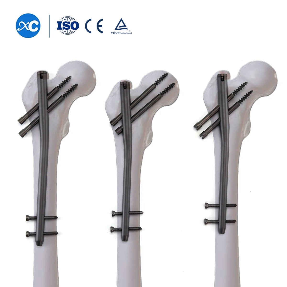 China Factory Orthopedic Implants Intramedullary Nailing For Simple Fracture Small Incisions Pfna Gamma Intramedullary Nail