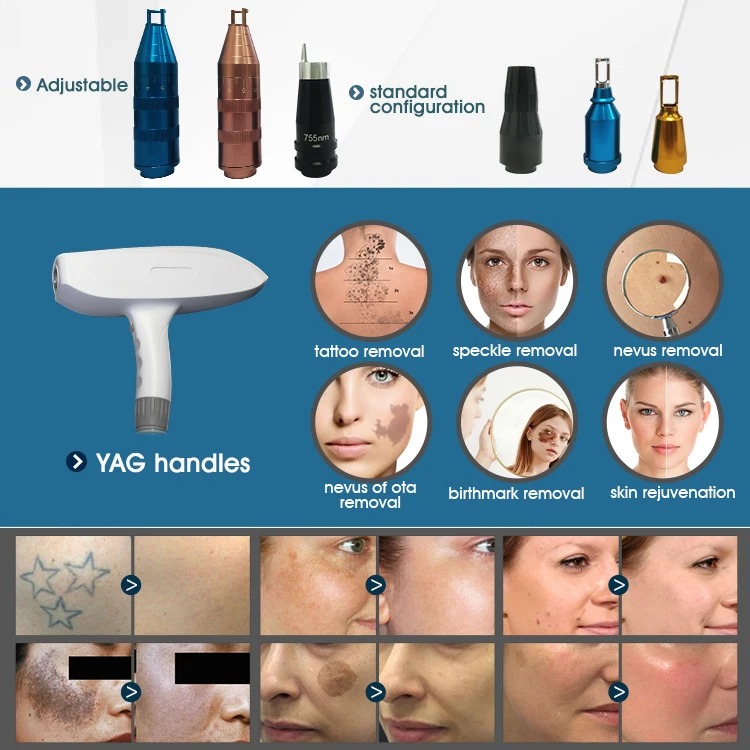 2024 upgrade 4 in 1 multifunctional SPRT SHR IPL rf e-light nd yag lasering machine