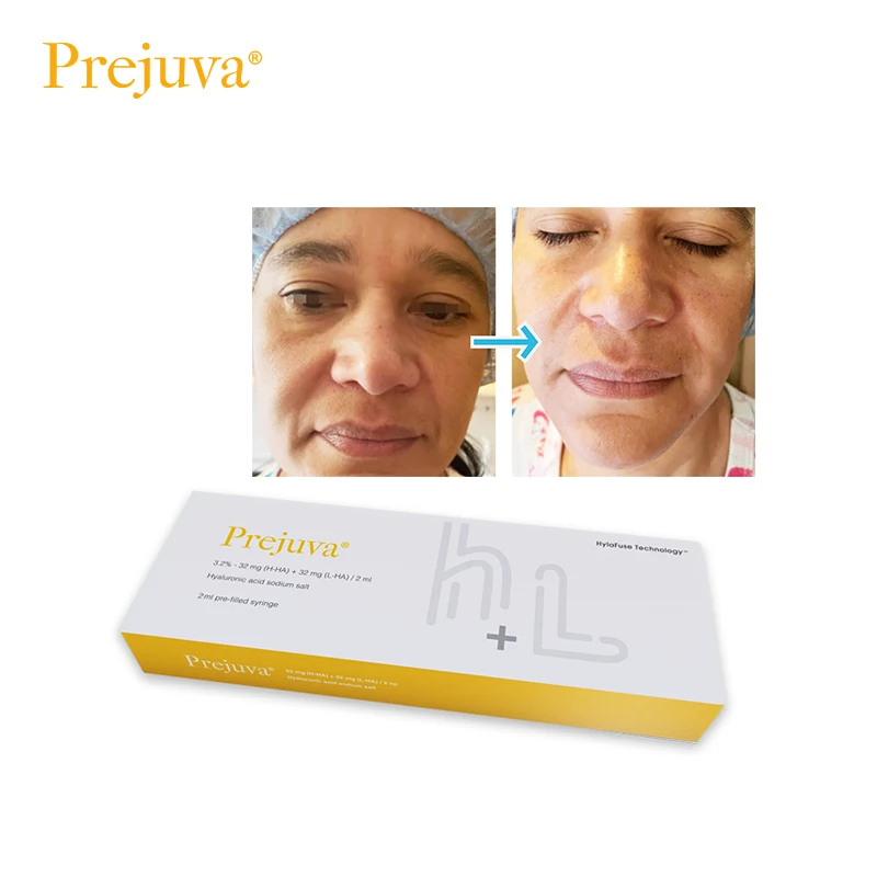 Prejuva Bio-Remodelling Product Hyaluronic Acid Forehead Dermal Filler Anti Wrinkles Skin Booster