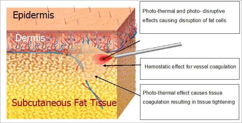 2020 Top sale 980nm Diode Laser for Liposuction