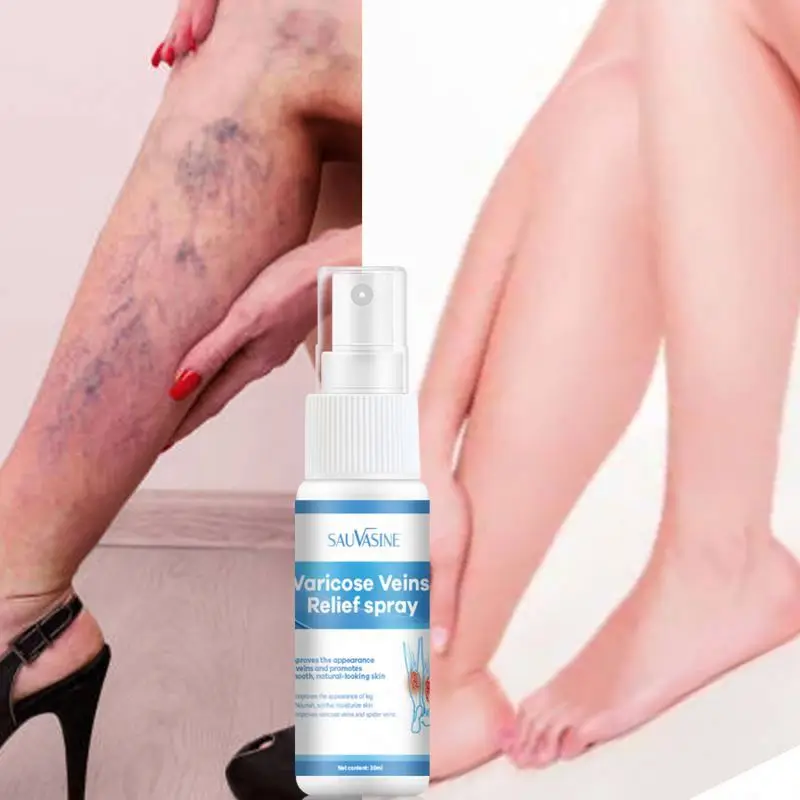 Spray Relief Phlebitis Angiitis Remedy Patch Spider Veins Edema Nerve Pain Earthworm Leg treatment cream Varicose Vein Spray