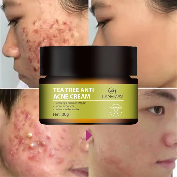 Acne Treatment Cream Anti Acne Face Cream Pimple Removal Spots Oil Control Shrink Pores Moisturizing Skin Care Cream