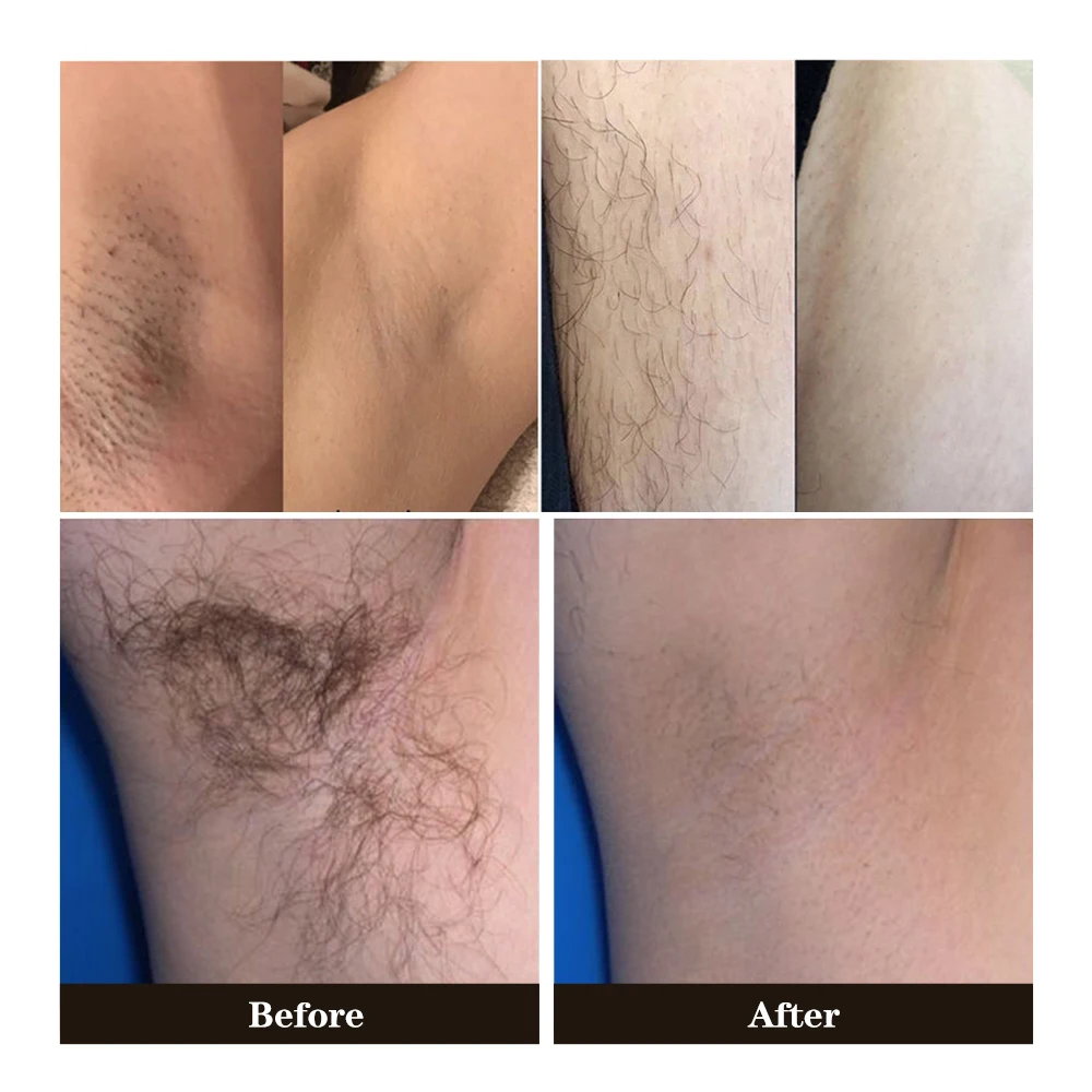 High Power Depilator Aesthetic Diode Removal Machine Laser Hair Removal 808nm 3 Wavelength Stationary 755nm 808nm 1064nm 