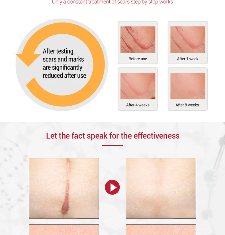 Light Print Scars Removal Face Cream Beauty Pure Skin Care Whitening Facial Moisturizing Acne Treatment Face Burn Scar Removal C