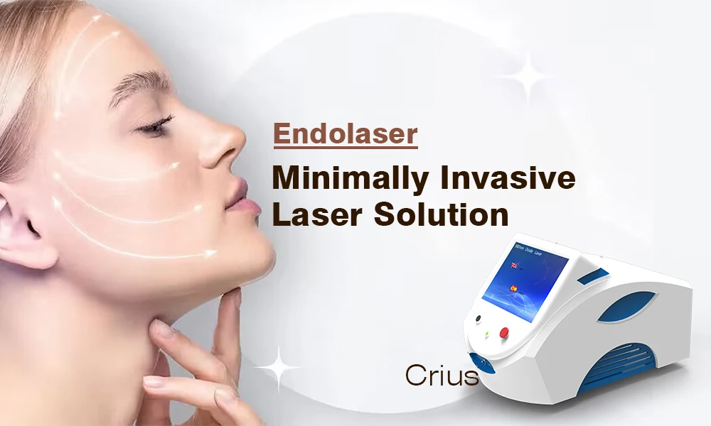 endolift endolaser laser.jpg