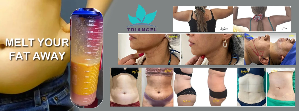 980 1470nm diode laser lipolysis machine liposuction canula endolaser machine fiber optic price