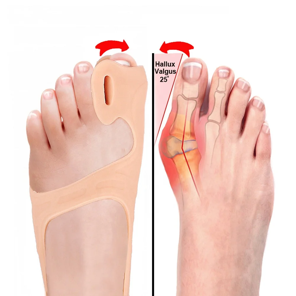Toe Separator Big Toe Straightener Toe Alignment Bunion Corrector Ingrown Toenails Protector Overlapping Hallux Valgus Corrector
