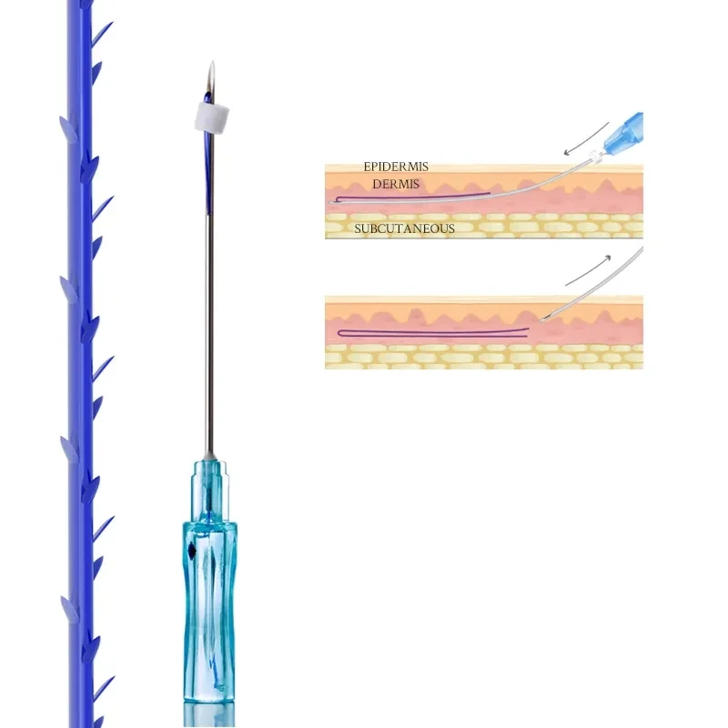 Beauty ce absorbable fox eye brow barbed 4d cog 23g hilos tensores pdo threads lift korea