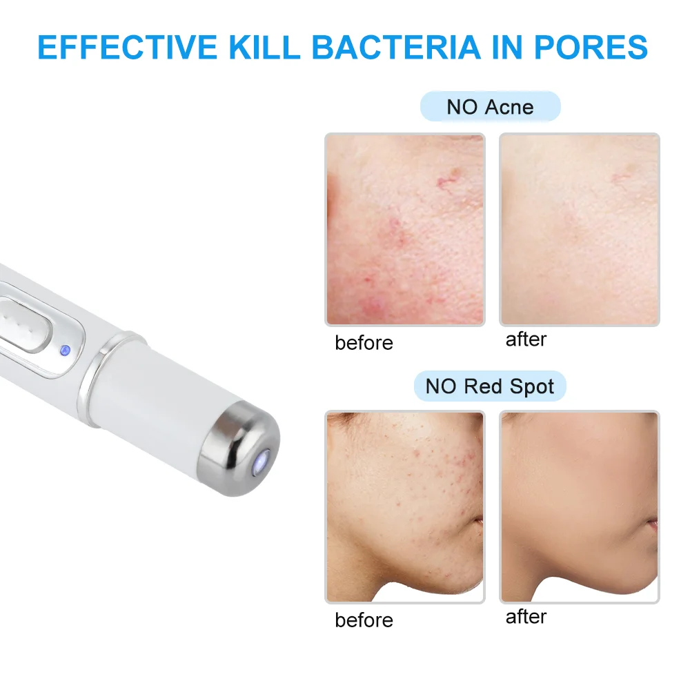 Therapy Acne Laser Pen Soft Scar Wrinkle Removal Treatment Device Skin Care Beauty Equipment