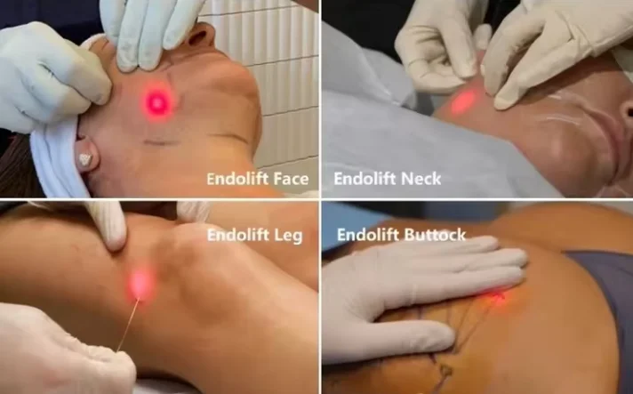 Fiber Endolaser Lipolysis Facial Body Lifting 980 1470nm Diode Laser Liposuction Canulas Fat Dissolving Medical Surgical Machine