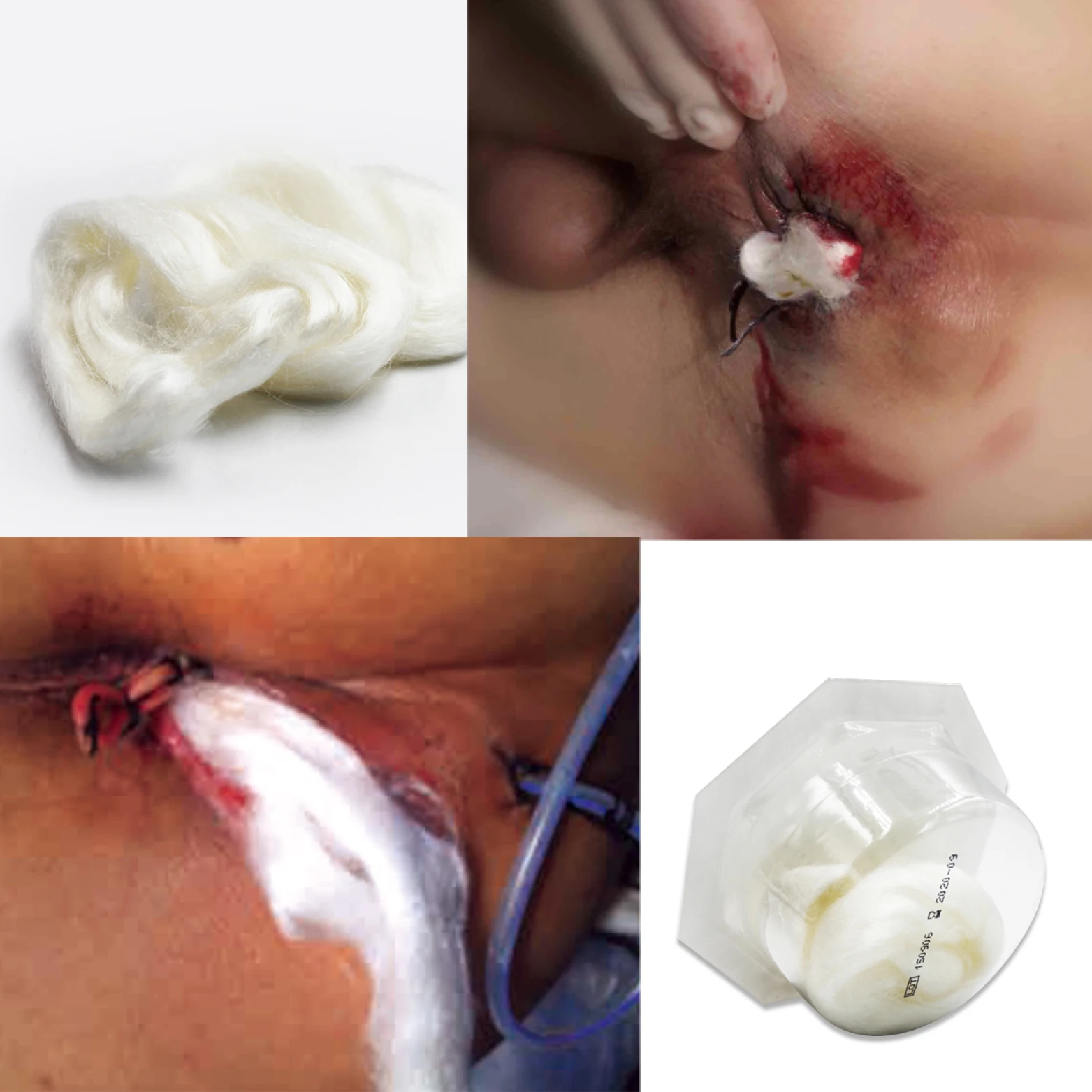 Absorbent Moist Healing Wound Care Medical High-tech Sterile  Ag Silver Alginate ION Dressing