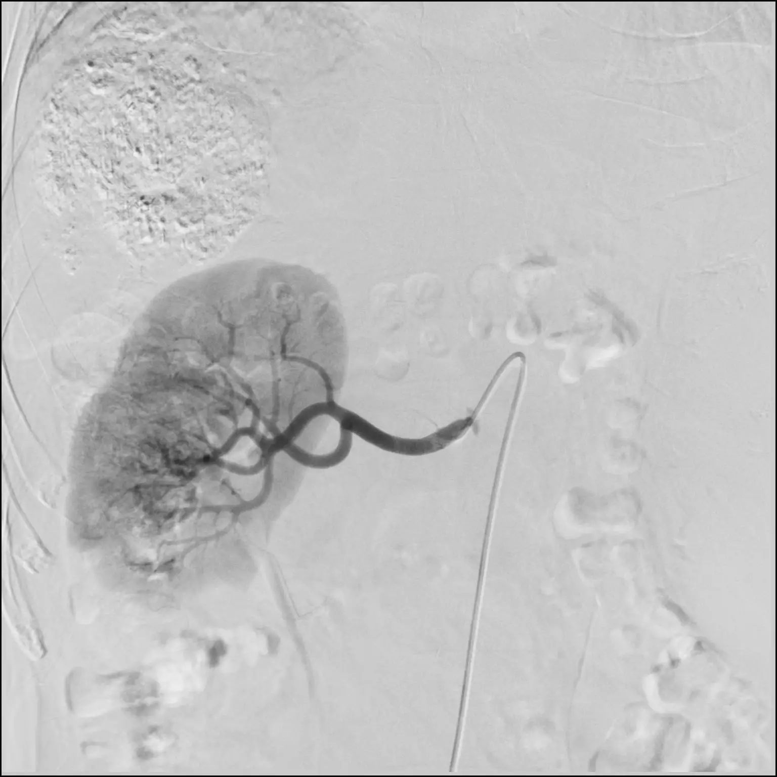 Liquid Metal X-ray Tube Large Size Flat Panel Detector Medical DSA System With Single Plane