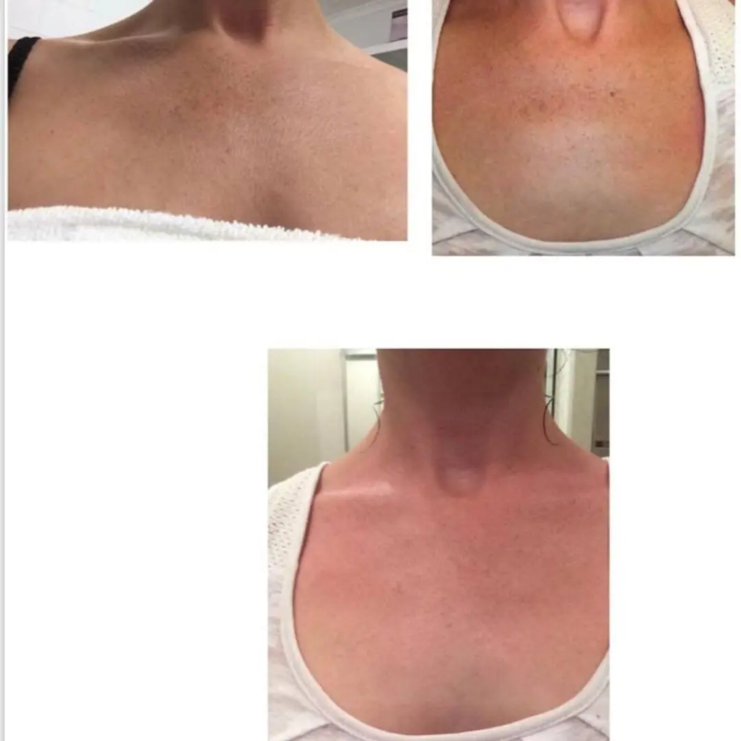 Newest laser hair machine  755 808 1064nm  Diode laser 3 wavelength  no affect on normal daily life